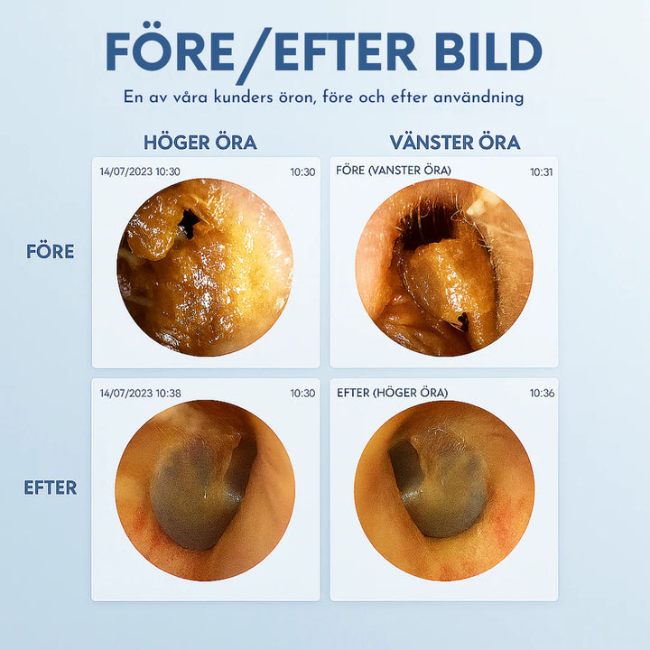 SafeEar™ – Säker, skonsam och effektiv öronrengöring för hela familjen